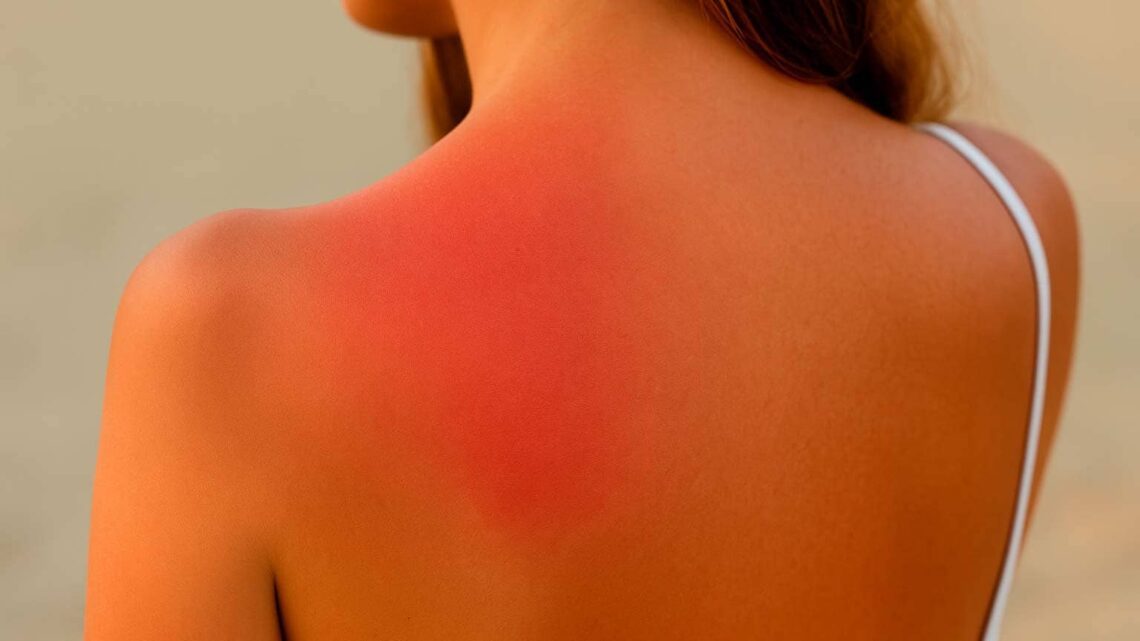 cuánto tarda en regenerarse la piel quemada por el sol