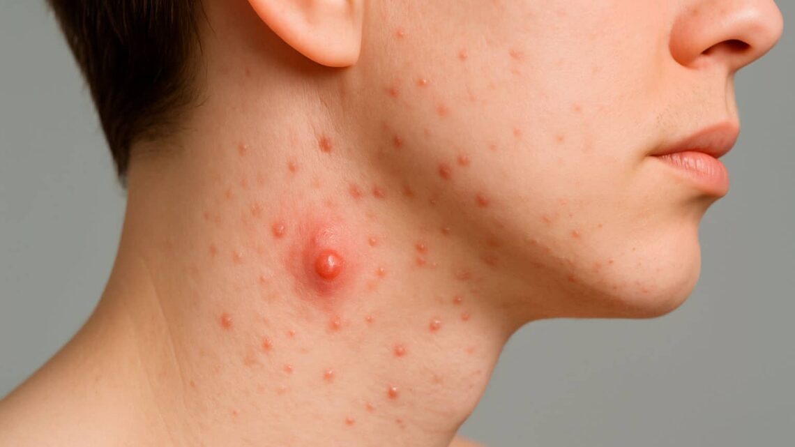 tipos de granos en el cuello