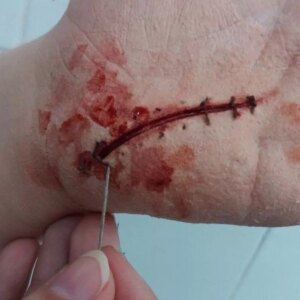 Marca: HARPO H.R.P.. Imagen: herida-puntos.jpg. Herida Puntos